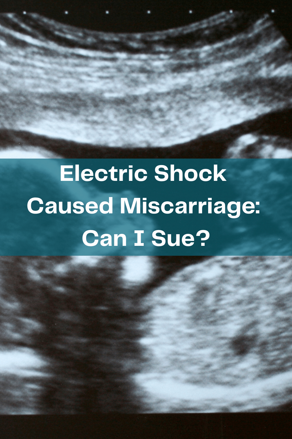 Electric Shock Caused Miscarriage: Can I Sue?